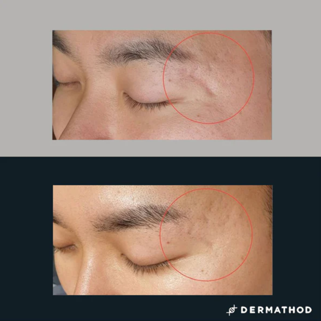 DERMA Ez Jet - MULTI Effektor tűs ampulla