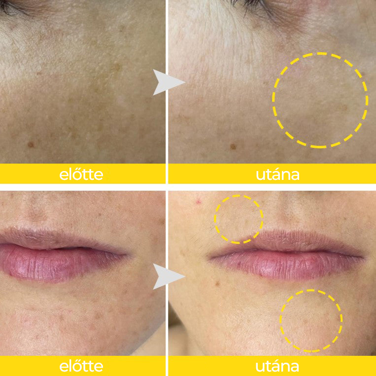 Vita Crush terápia készlet