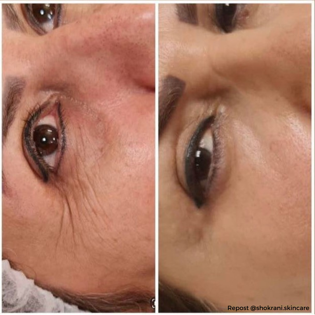 KRX Meso prémium Szemkörnyék ápoló szérum