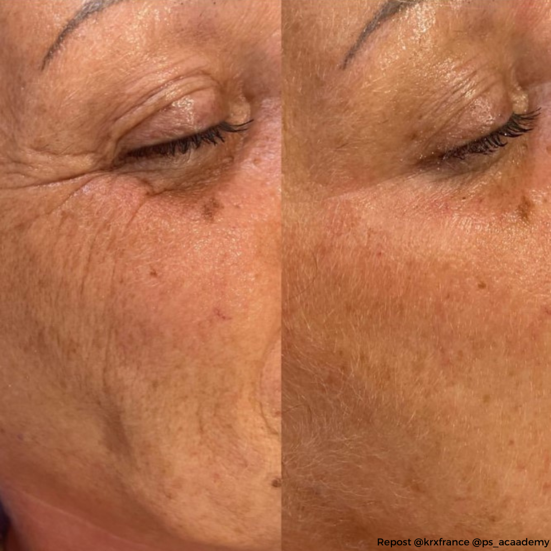 THREAD-FILL KOLLAGÉNSZÁL