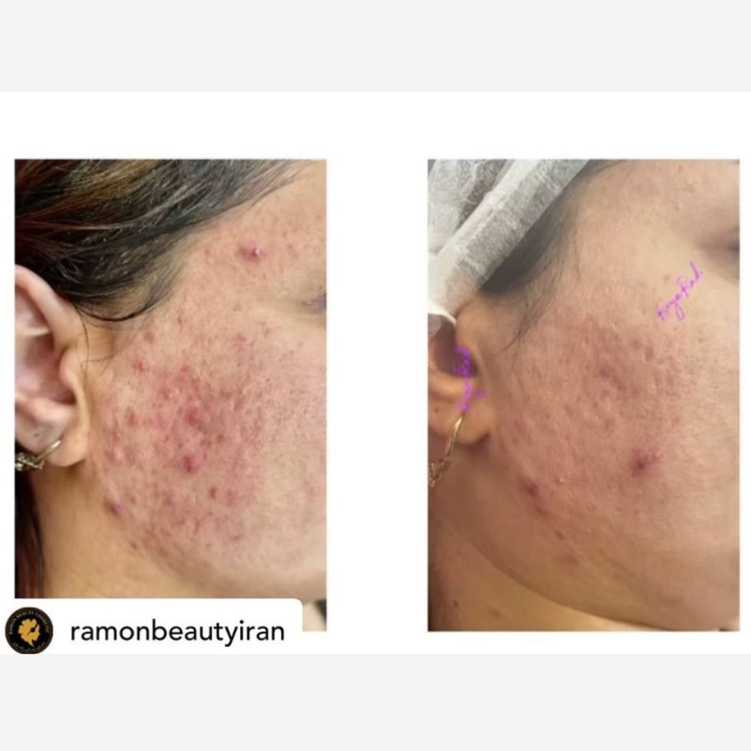 KRX Meso Booster Acne Ampulla 5ml