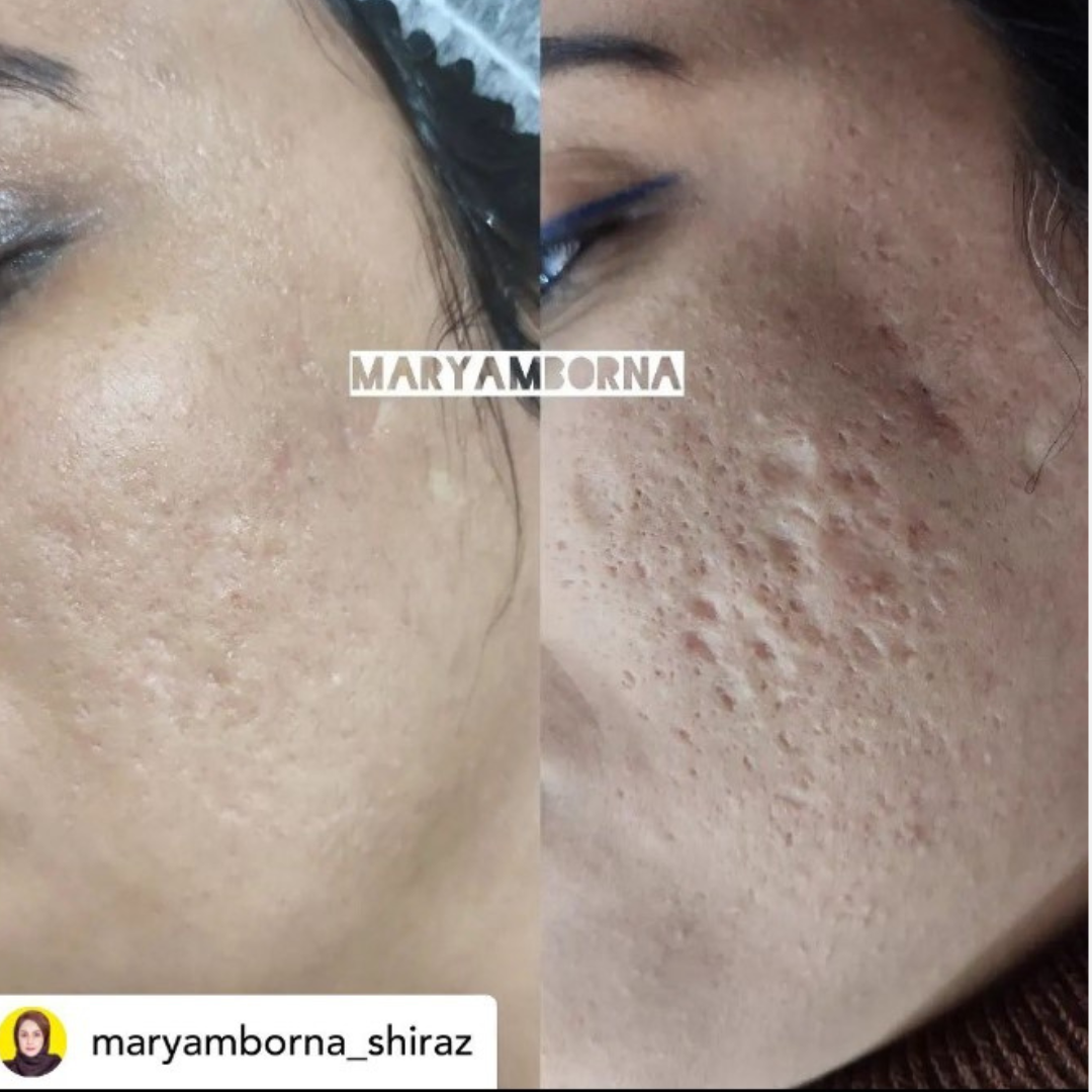 SZÁLLÍTÁS ALATT VAN ELÉRHRTŐ 10.17.KRX Meso Booster Lazac DNA Peptide Ampulla 5 ml