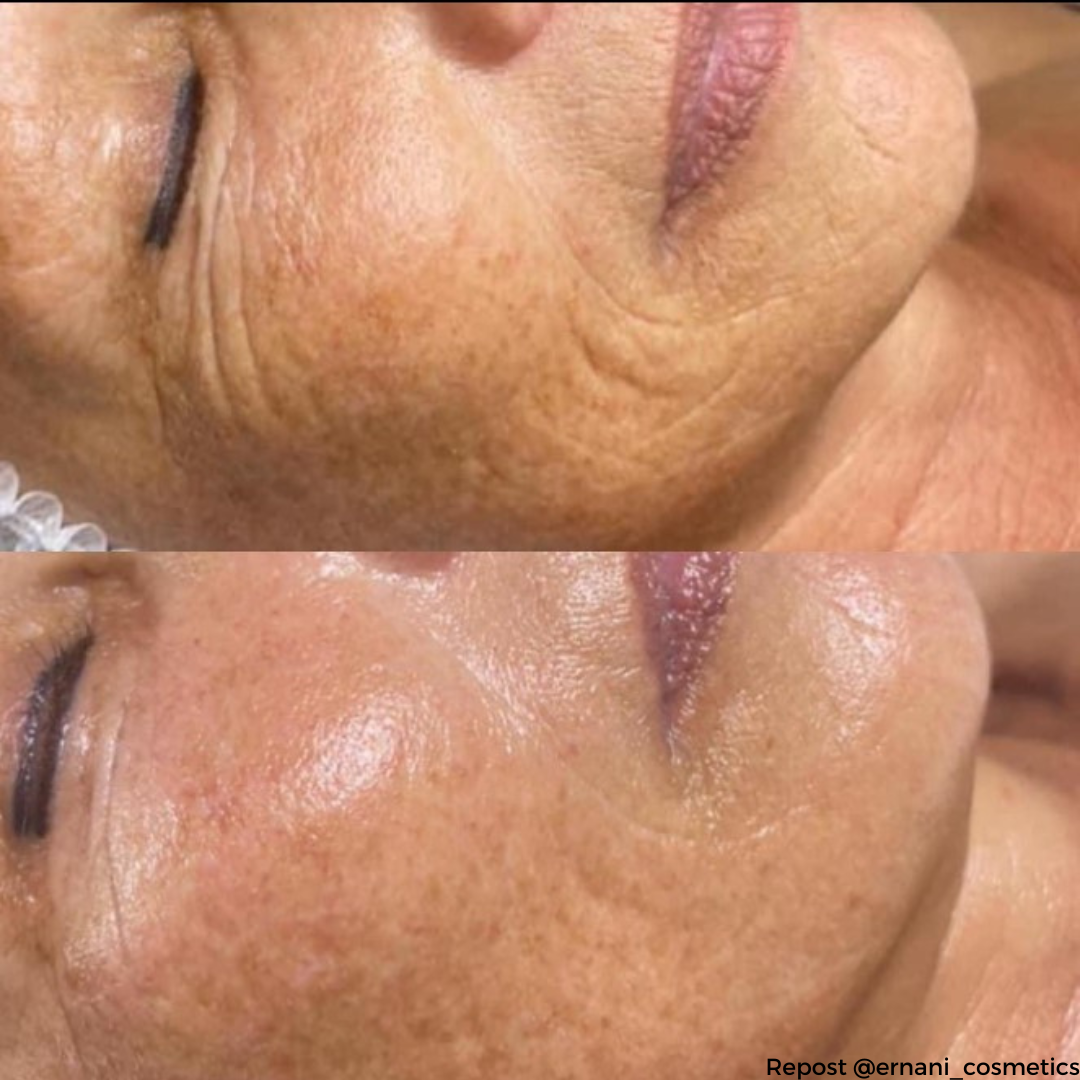 THREAD-FILL KOLLAGÉNSZÁL