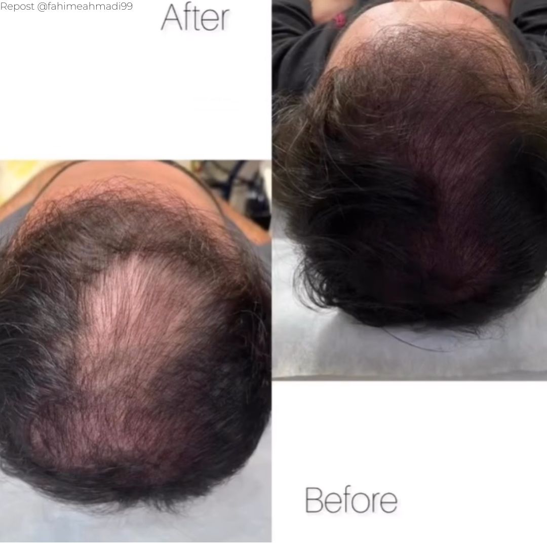 KRX Meso prémium Hair szérum