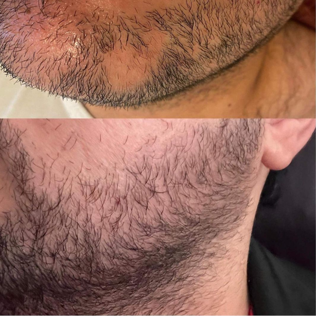 KRX Meso prémium Hair szérum