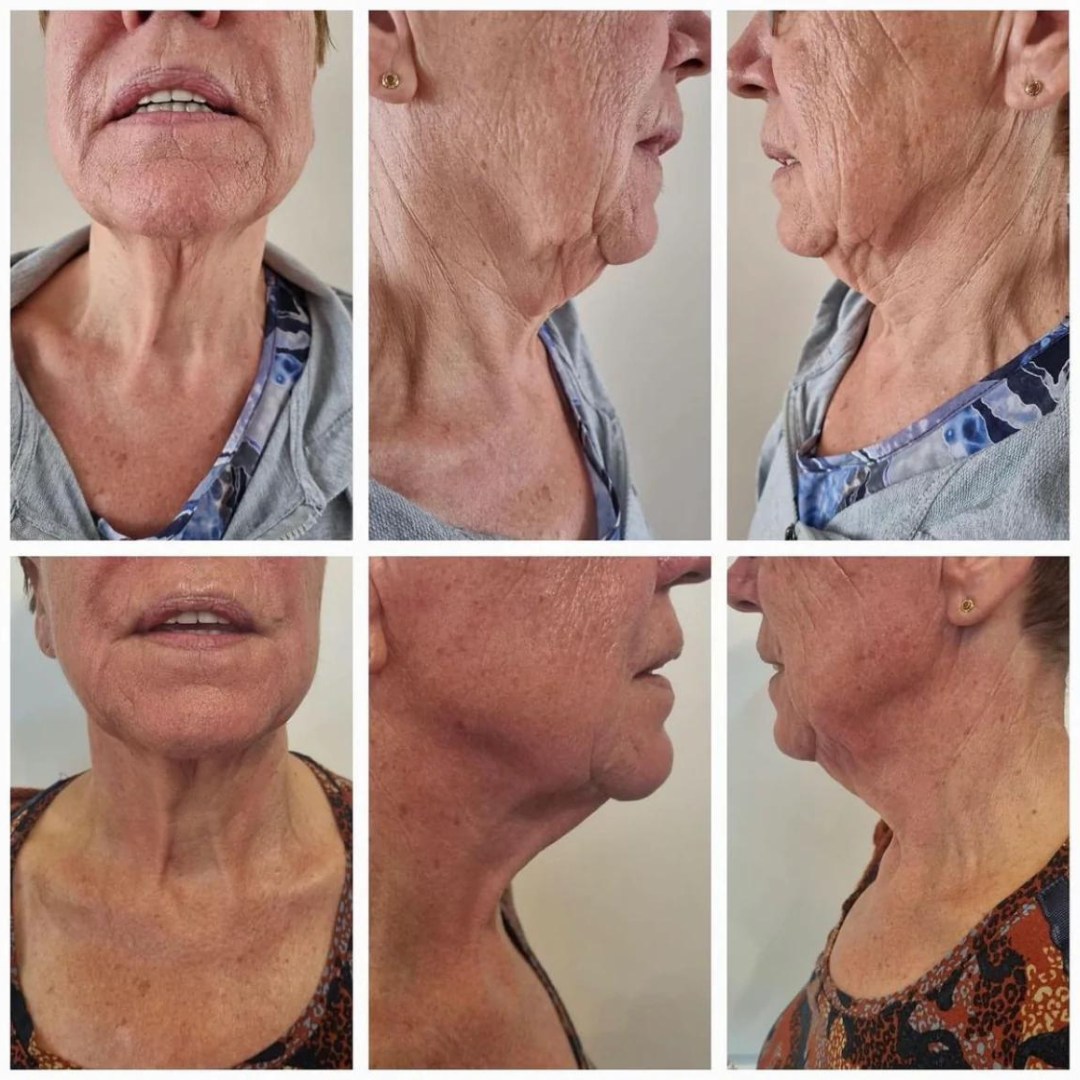 Kollagénes nyak és dekoltázs krém LIMITÁLT KIADÁS