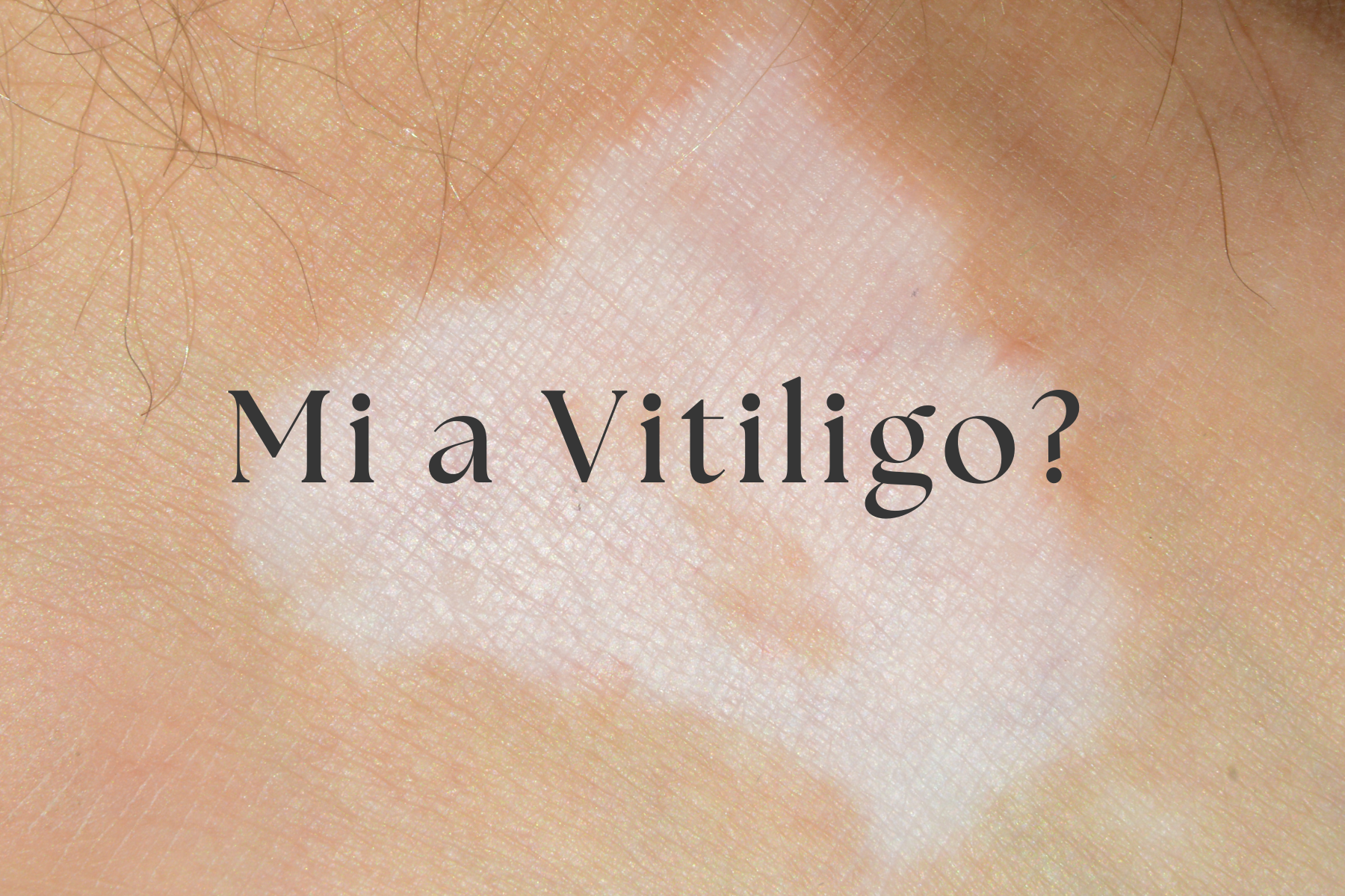 Mi az a vitiligo?