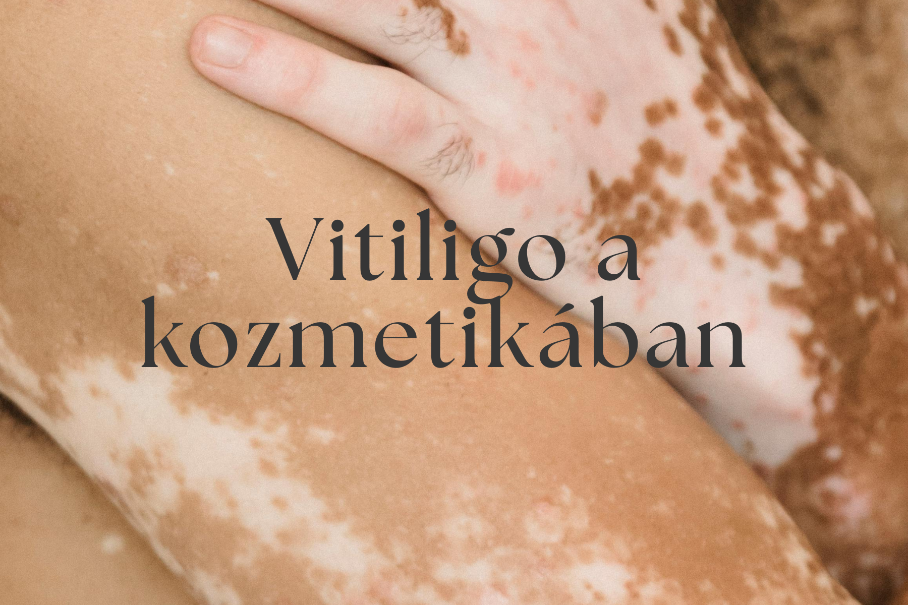 Vitiligo a kozmetikaban