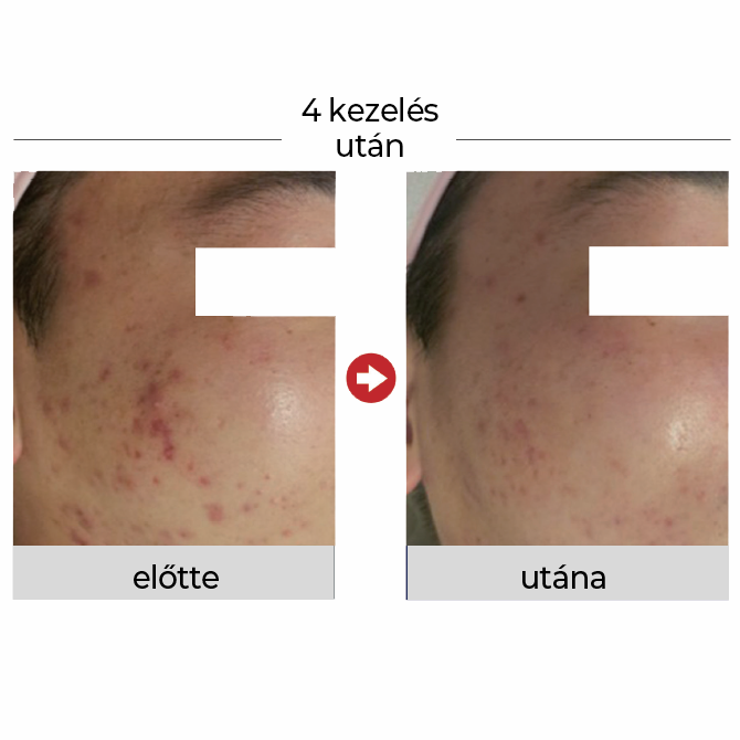 F.G.F. bőrfiatalító kezelő szett