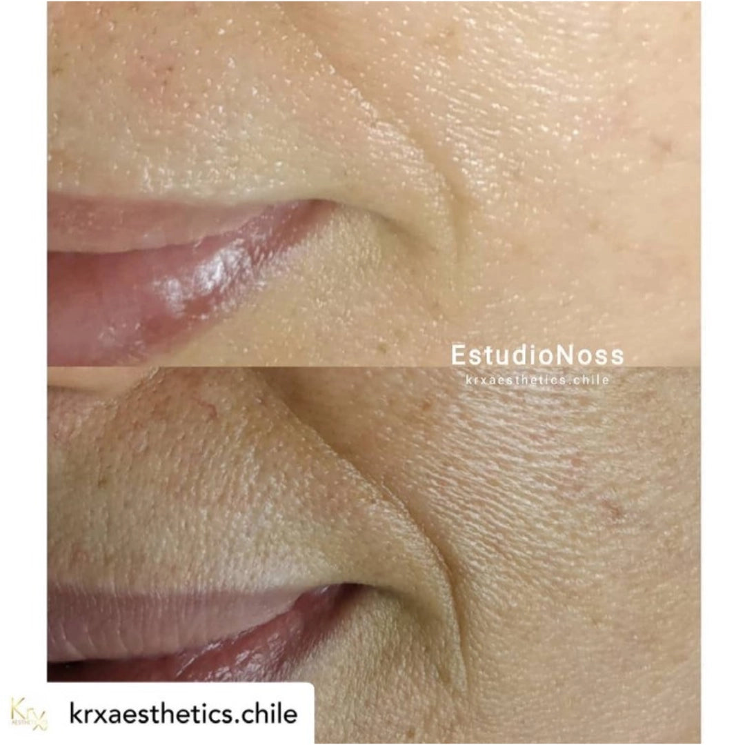 KRX Meso Booster BotoRX Ampulla 5ml