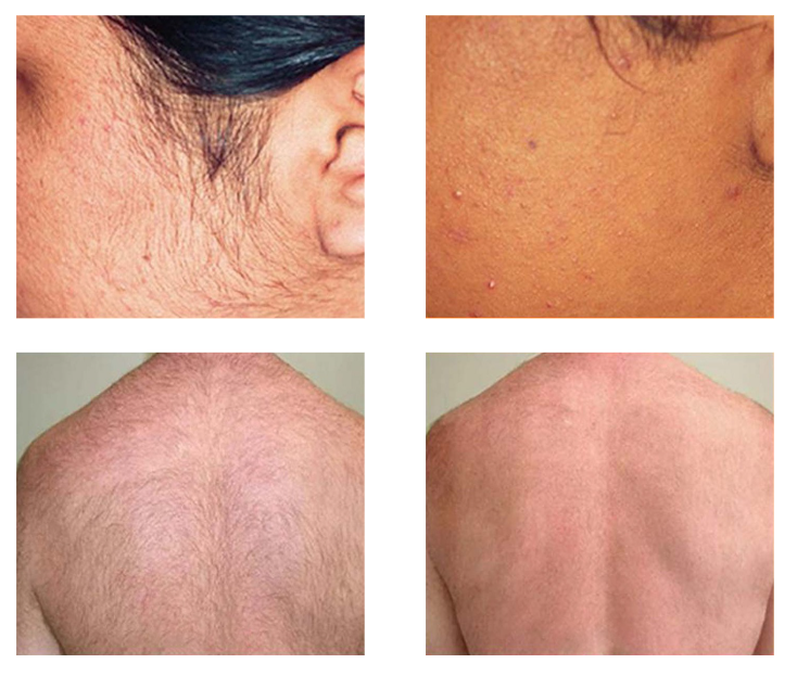 2:1 PRO Salon Dióda és YAG