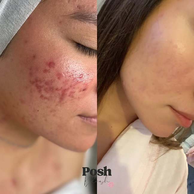 Green Sea Peel 1 kezelés csomag🧪