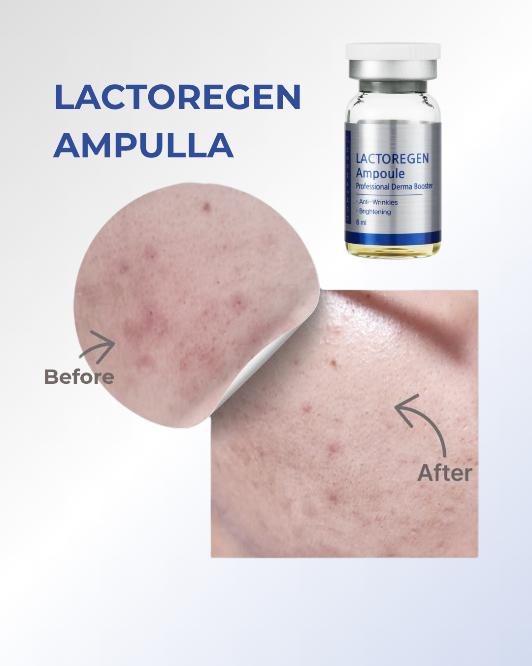 Lactoregen Barrier boost kezelőcsomag