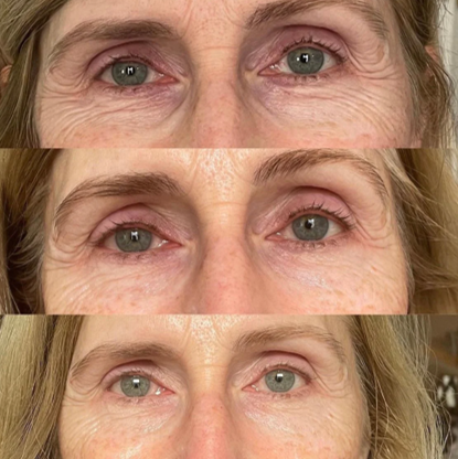 V-TOX effekt maszk
