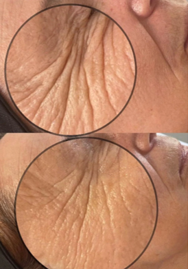 V-TOX effekt maszk