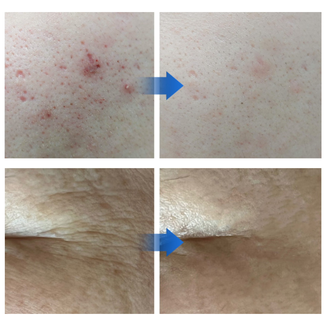 DERMA Ez Jet - MULTI Effektor tűs ampulla
