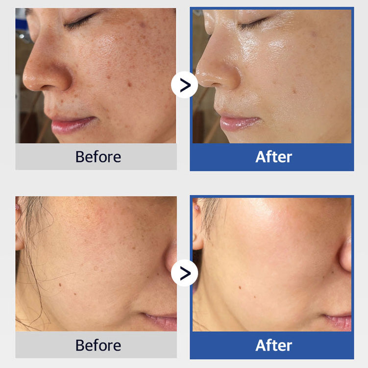 Dactor Peel- KOREA PEEL arcra