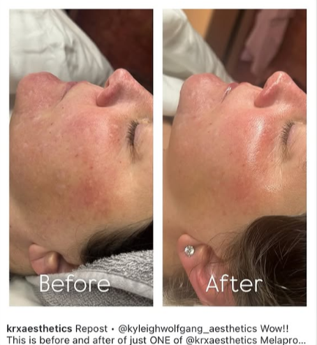 MelaPro Plus hideg peeling